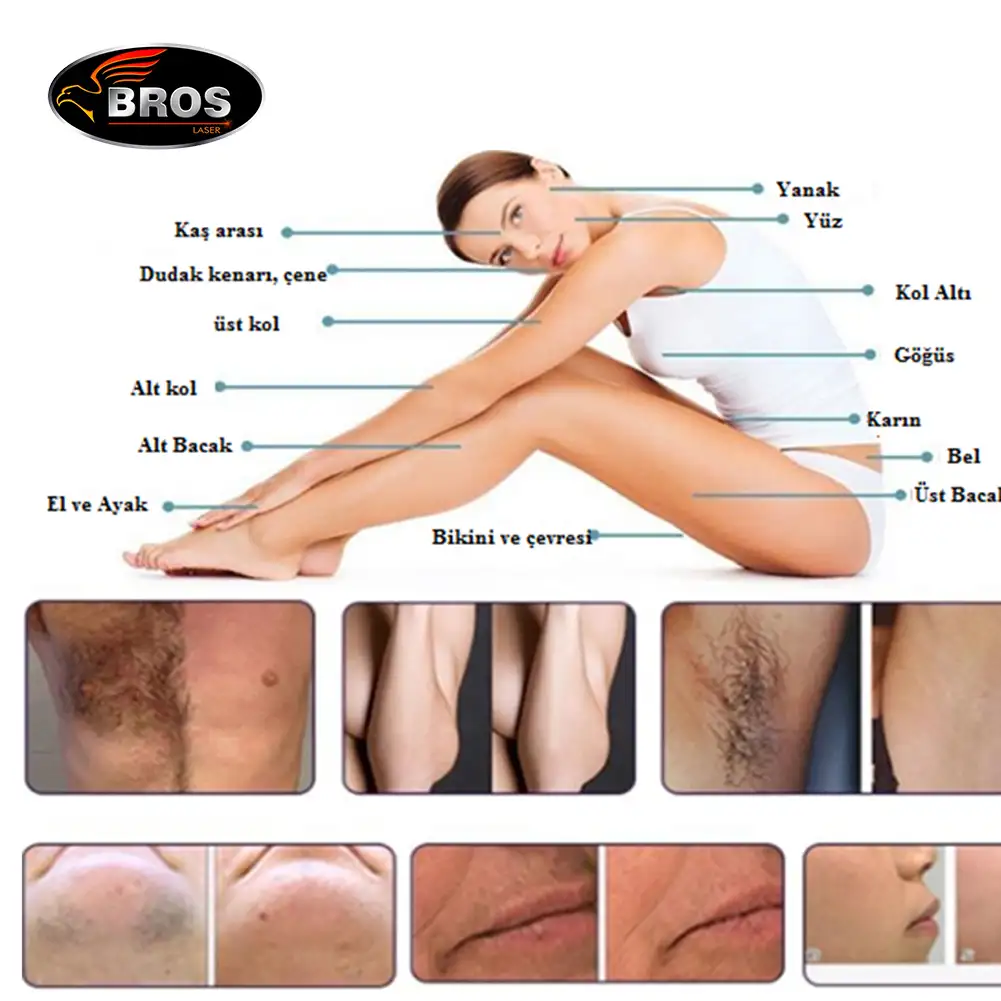 Diyot Lazer Epilasyon Cihazı