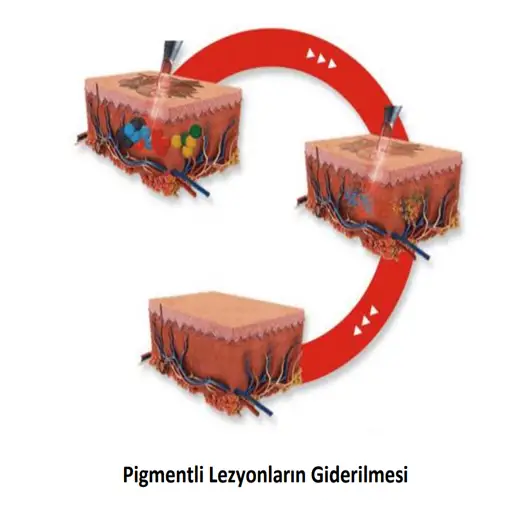 Picosaniye lazer pigment