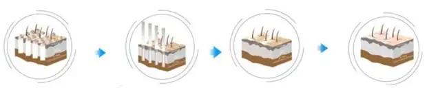 surgynder co2 fractional laser