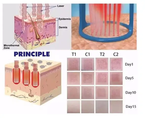 surgynder co2 fractional laser