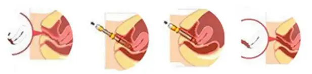surgynder co2 fractional laser