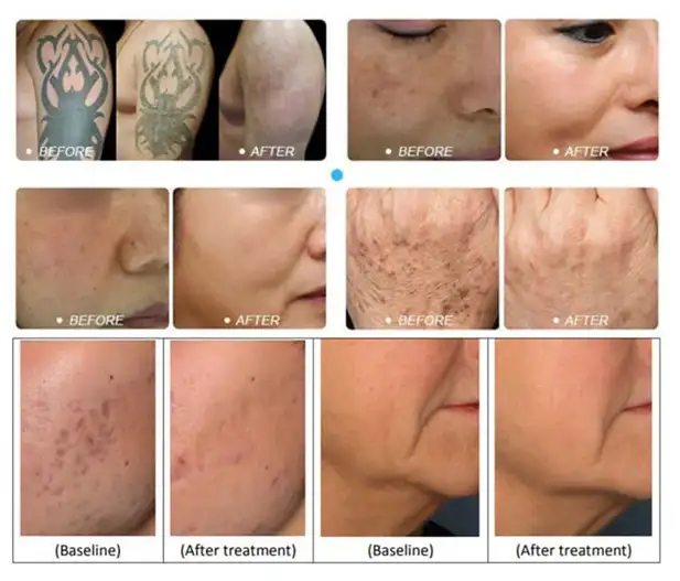 Tatto laser ink