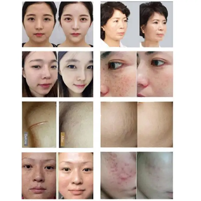 Needle micro igne modu Needle mode