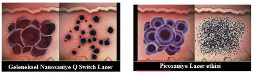 ND YAG Q Switch Lazer 500 pico