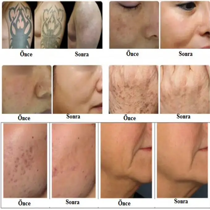 ND YAG Q Switch Lazer 500 pico