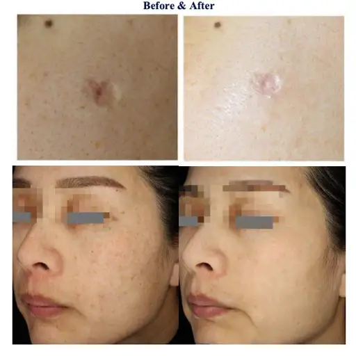 Picosecond laser picosaniye lazer