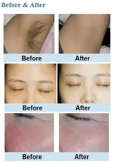 OPTIMUM SHR IPL Hair Removal bros laser