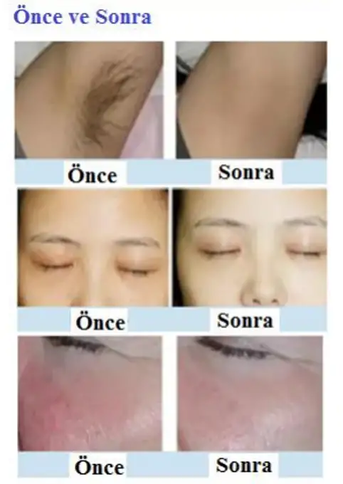 OPTIMUM SHR IPL Cihazı Bros lazer medikal